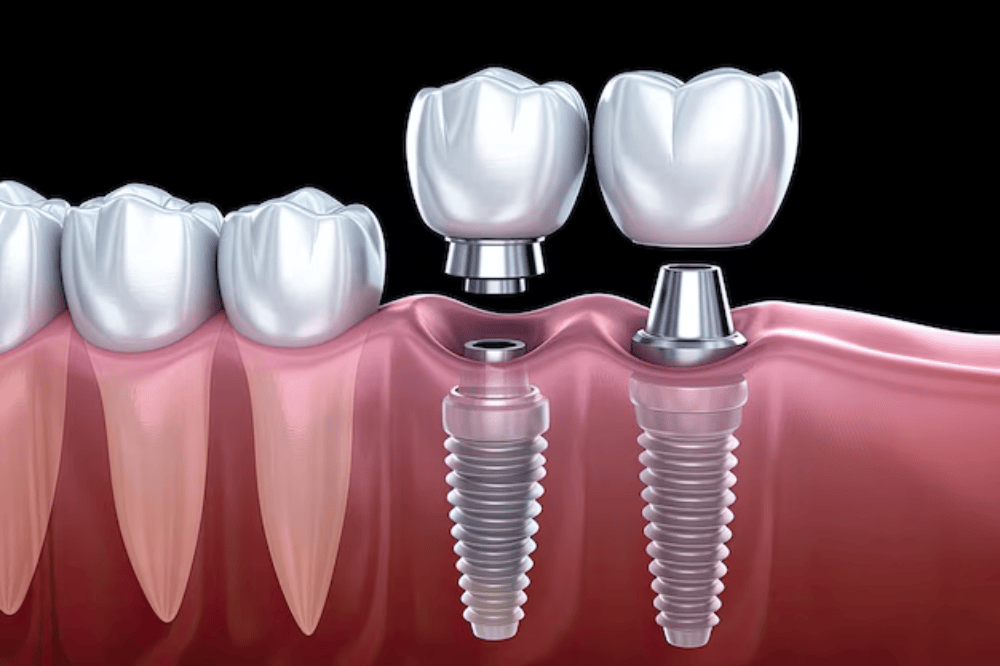 What Happens to Surrounding Bone Density When Dental Implants Are Delayed After Tooth Loss